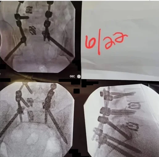 Kate's post-operative X-rays showing the SI fusion hardware, dated June 2022