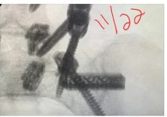 X-ray detail, dated November 2022