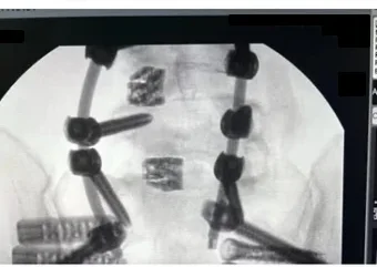 Post-operative X-ray of the PML SI fusion